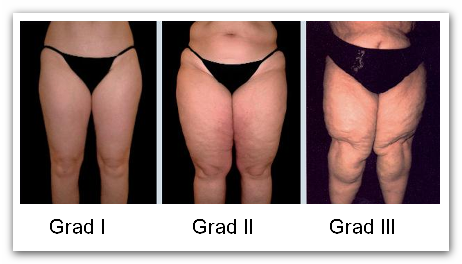 Einteilung des Lipödems in Stadien