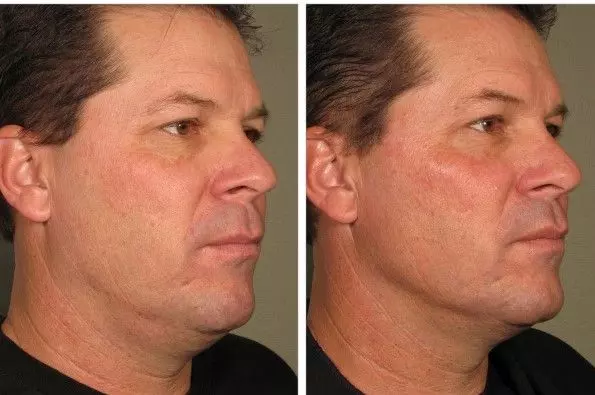 before and after pictures of a man's face