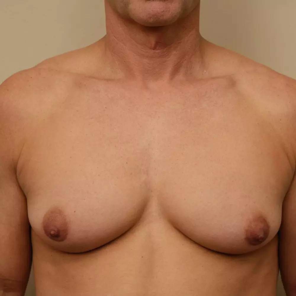 Male chest before and after breast lift surgery, side by side comparison in a medical setting, Photographic, Photography with high resolution and clinical lighting.