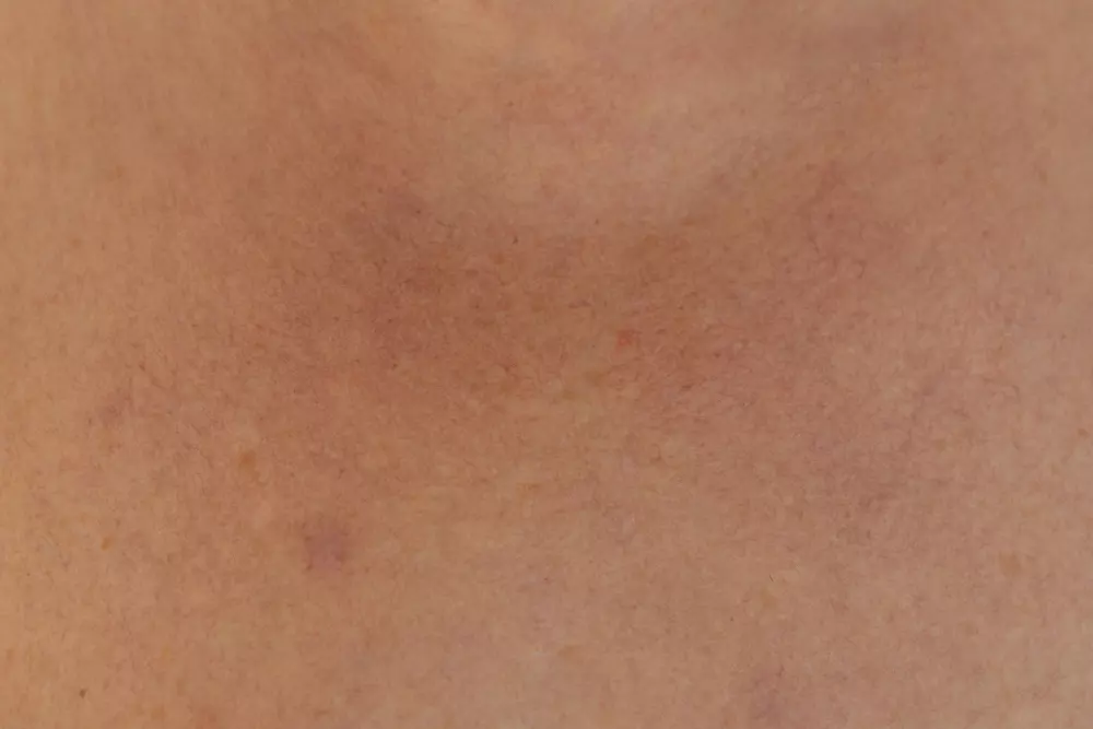 Eine Nahaufnahme des Rückens einer Person mit Akne darauf