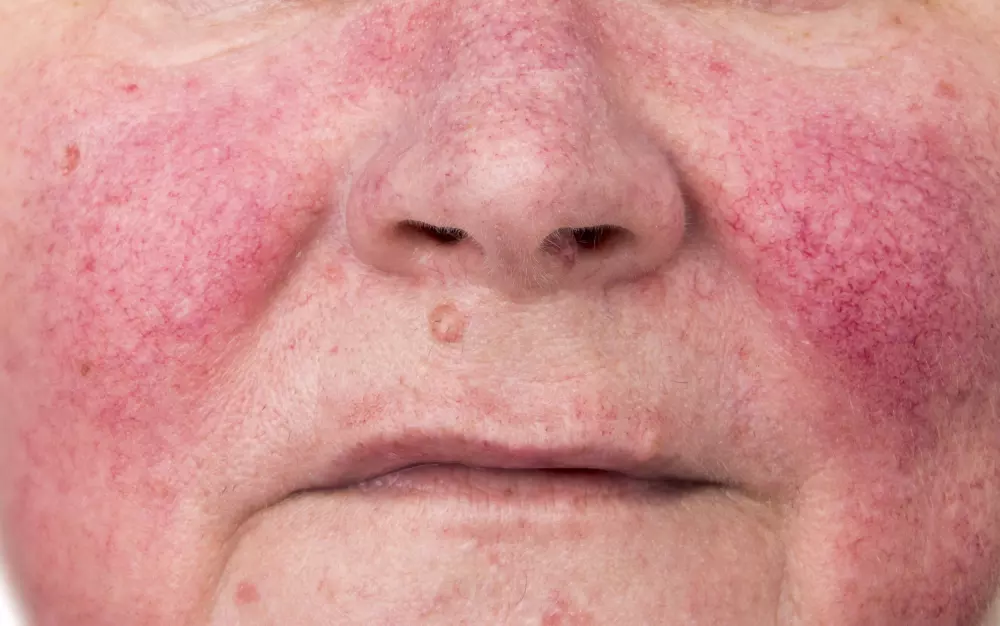 a woman's face with red rhinitis