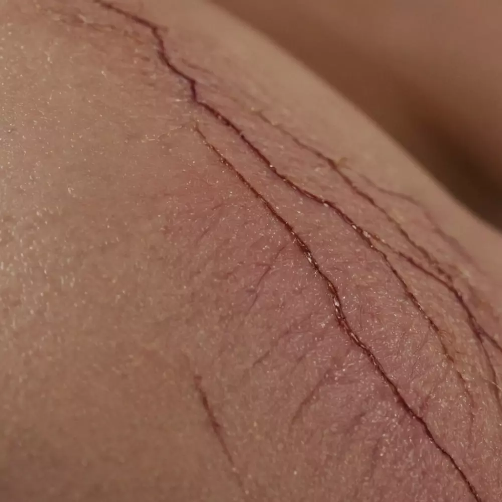 Nahaufnahme einer komplexen Narbe auf der Haut, die Unregelmäßigkeiten und Texturen hervorhebt, in einer klinischen Umgebung, fotografisch festgehalten mit einem Makroobjektiv, das auf detaillierte Schärfe und weiches Studiolicht setzt.