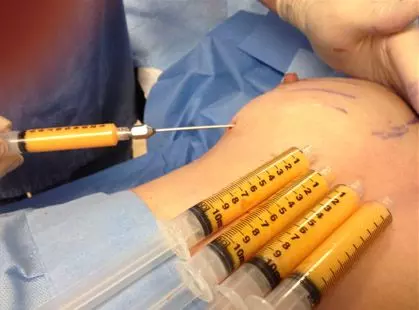 syringes being inserted into a patient's stomach
