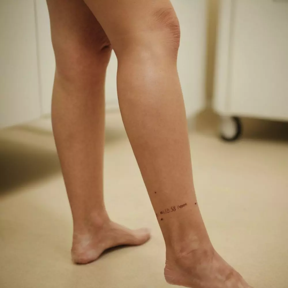 Nahaufnahme der Waden einer Person, markiert mit einem Operationsstift, um die Schwerpunktbereiche für eine Fettabsaugung hervorzuheben, aufgenommen in einer gut beleuchteten klinischen Umgebung, fotografisch festgehalten mit einem Makroobjektiv, um die Details der Haut und Markierungen zu betonen.