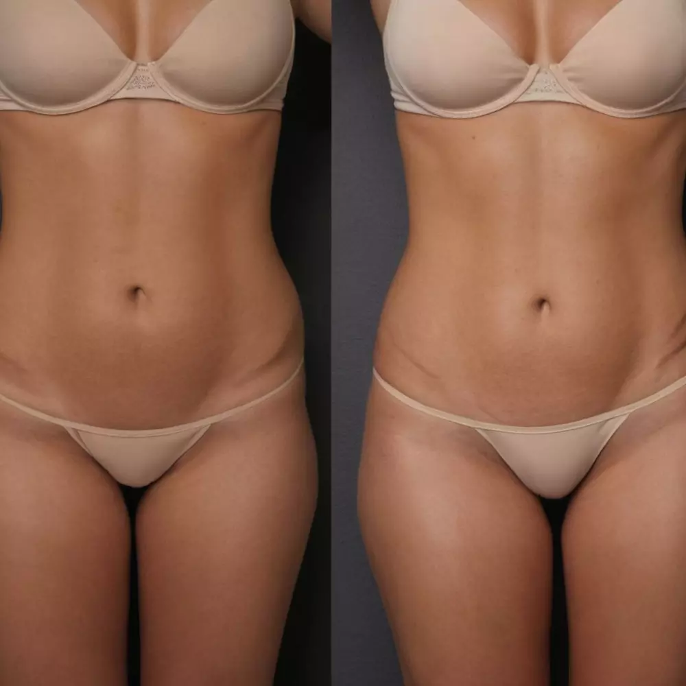 A before and after comparison of abdomen contouring on a medical background, with clear visibility of improved contour, with a calm and optimistic atmosphere, in a Photographic style, captured in a high-resolution close-up.