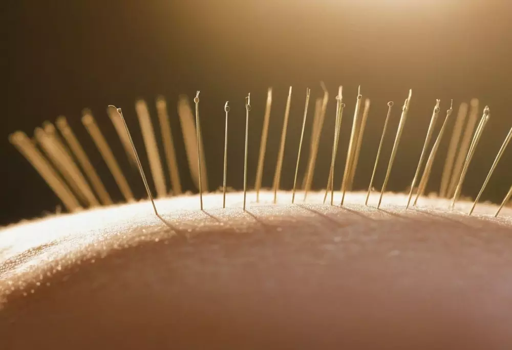 Primer plano de agujas de acupuntura en la espalda de una persona, con enfoque en la disposición y precisión, ambientado en un entorno tranquilo y terapéutico, con una suave iluminación natural, capturado en un estilo fotográfico detallado utilizando un lente macro para obtener nitidez en los detalles.