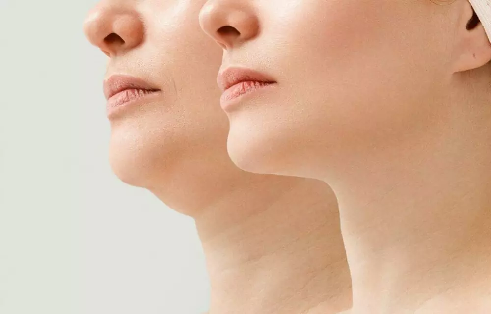 a woman's face before and after liposuction