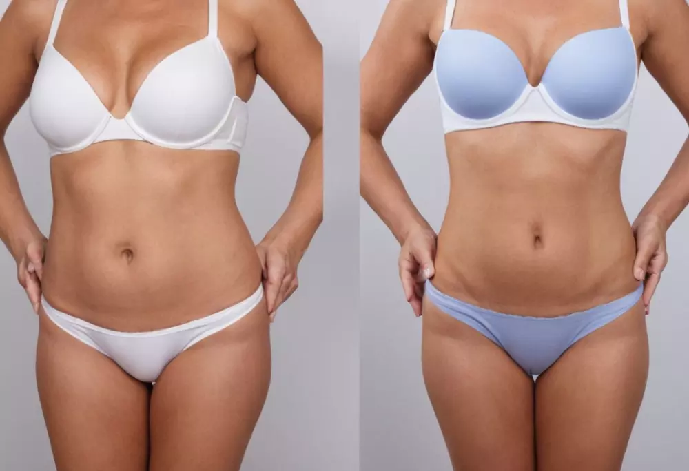 Collage of non-invasive body contouring techniques, showcasing devices like liposuction machine, ThermiTight, and CoolSculpting in a professional medical setting, bright and clean, captured in a medium shot with a 50mm lens, in a photographic style, realized with studio lighting and high resolution.