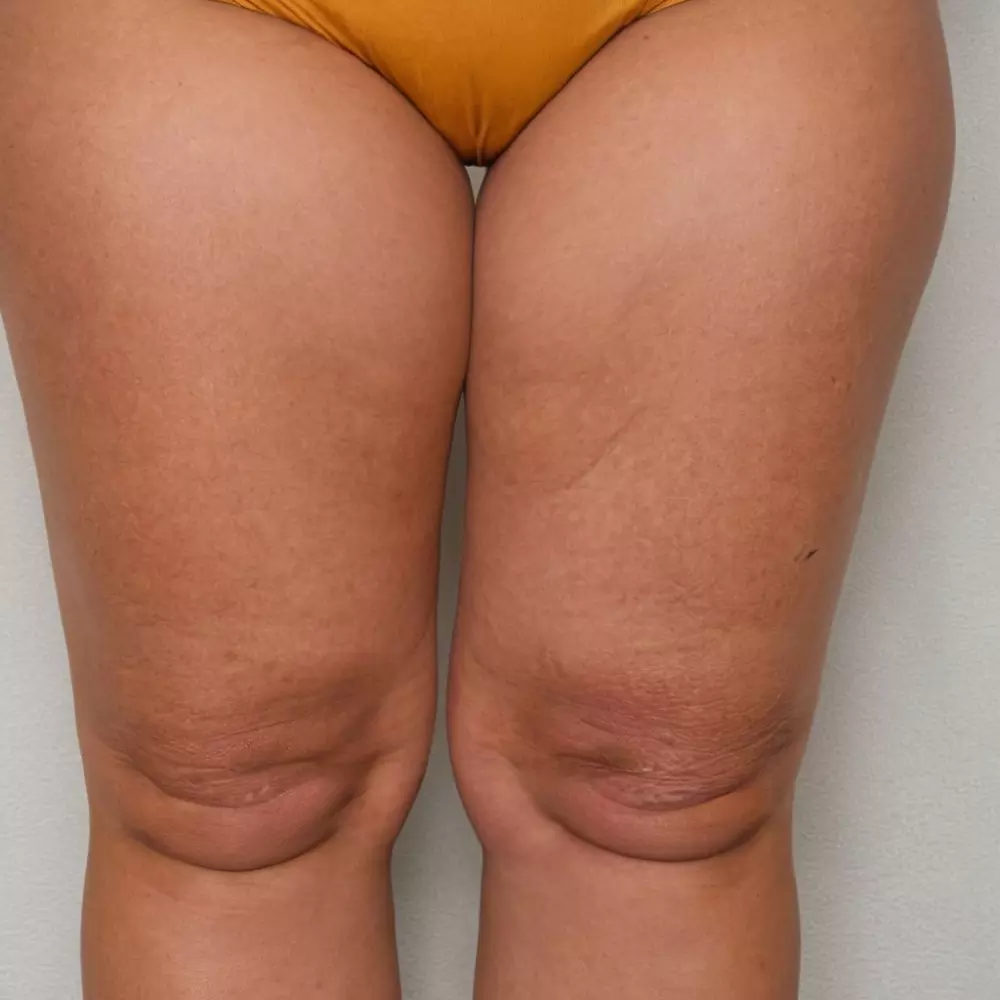 Fotos antes y después de una pierna mostrando reducción de celulitis debido al drenaje linfático, una al lado de la otra, fotografía con alta resolución y textura detallada para mostrar claramente la mejora en la piel.