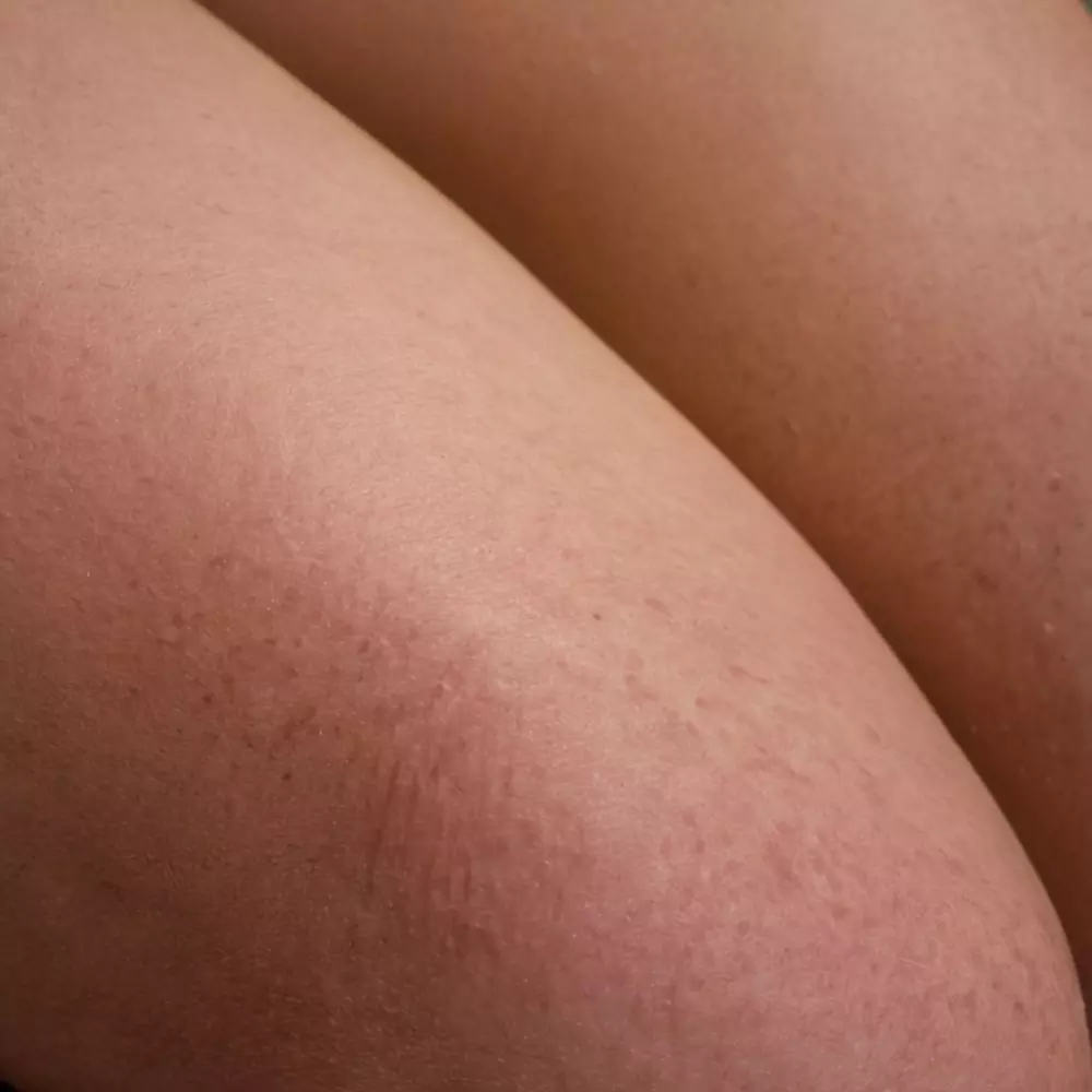 Nahaufnahme eines geschwollenen Beins mit Rötung und Schwellung, detaillierte Hauttextur, in einem klinischen Umfeld, weiches klinisches Licht, Fotografie, Fotografie mit einem detaillierten Fokus auf Hauttextur unter Verwendung eines Makroobjektivs.