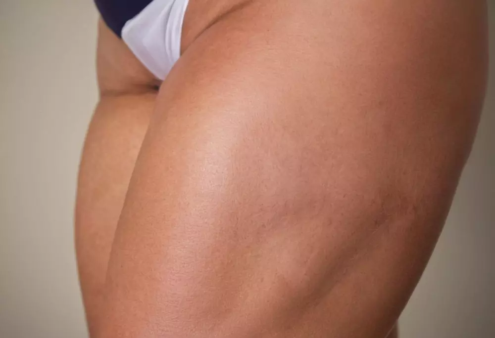 Nahaufnahme eines weiblichen Beins, das typische Lipödem-Symptome zeigt, in einem medizinischen Umfeld, mit Schwerpunkt auf Hauttextur, fotografischem Stil, Makroobjektiv für detaillierte Hauttextur, hoher Auflösung und detaillierter Beleuchtung.