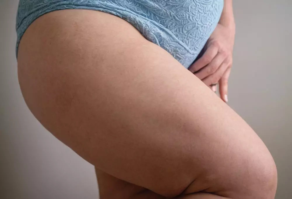 Nahaufnahme eines Fotos von den Beinen einer Frau, das die asymmetrische Fettverteilung charakteristisch für Lipödem zeigt, in einem klinischen Umfeld, mit Fokus auf der ungleichmäßigen Hauttextur. Fotografischer Stil, hochauflösendes Bild mit scharfem Fokus, um das asymmetrische Detail hervorzuheben.