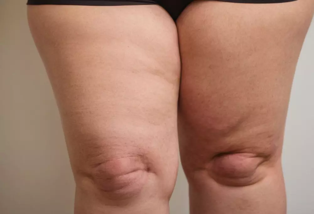 Nahaufnahme der Beine einer Frau, die Anzeichen von Lipödem zeigen, mit Fokus auf Hauttextur und Schwellung, im natürlichen Tageslicht. Fotografie, aufgenommen mit einem Makro-Objektiv, um die detaillierte Hauttextur einzufangen.