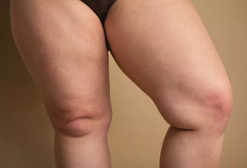 Nahaufnahme der Beine einer Frau, die typische Schwellungen und schmerzhafte Stellen zeigt, die mit Lipödem in Verbindung gebracht werden, in einem klinischen Umfeld, Fotografie, Nahaufnahme mit hoher Detailgenauigkeit und Klarheit.