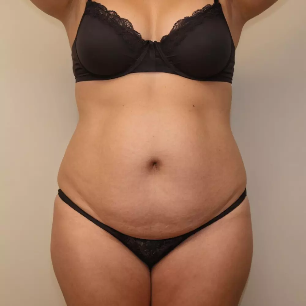 Ein hochwertiges Bild, das den Bauch einer Person vor und nach der Kryolipolyse-Behandlung zeigt, wobei eine deutliche Fettreduzierung hervorgehoben wird. Fotografie mit einem 35-mm-Objektiv, scharfem Fokus und natürlichem Licht.