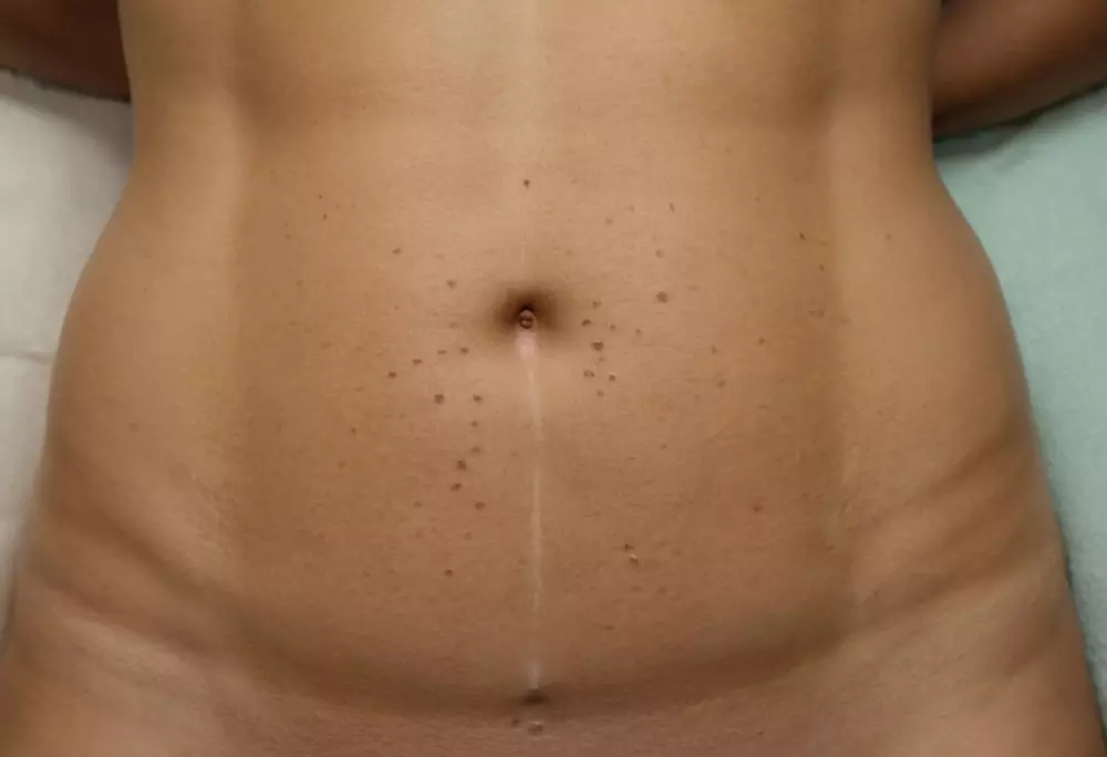 Nahaufnahme eines markierten Bauches, bereit für eine Kryolipolyse-Behandlung, mit Fokus auf die Haut mit temporären Markierungen, in einer klinischen Umgebung mit Tageslicht, wobei der behandelte Bereich betont wird. Fotografie, Nahaufnahme mit natürlicher Beleuchtung und hoher Detailgenauigkeit.