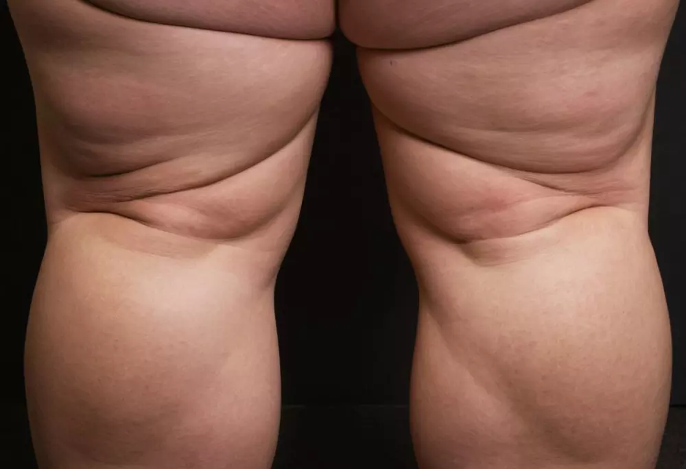 Nahaufnahme der Waden, die die charakteristischen Anzeichen von Lipödem zeigen, wie ungleichmäßige Fettverteilung und Schwellungen, in einem klinischen Umfeld. Fotografie mit hoher Auflösung, detaillierter Textursichtbarkeit und klinischer Beleuchtung.