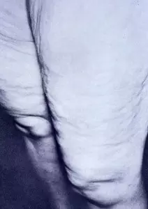 Fatty nodules in lipedema