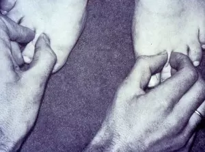 Stemmar-Test Lymphödem