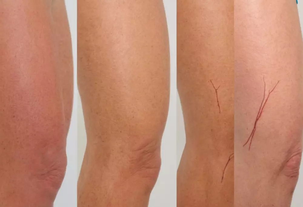 Zeitstrahl-Grafik, die die Phasen der Hautheilung nach der Lasertherapie bei Besenreisern zeigt, klar und informativ mit markierten Stadien, Fotografie einer gedruckten Zeitleiste auf hellem Hintergrund.