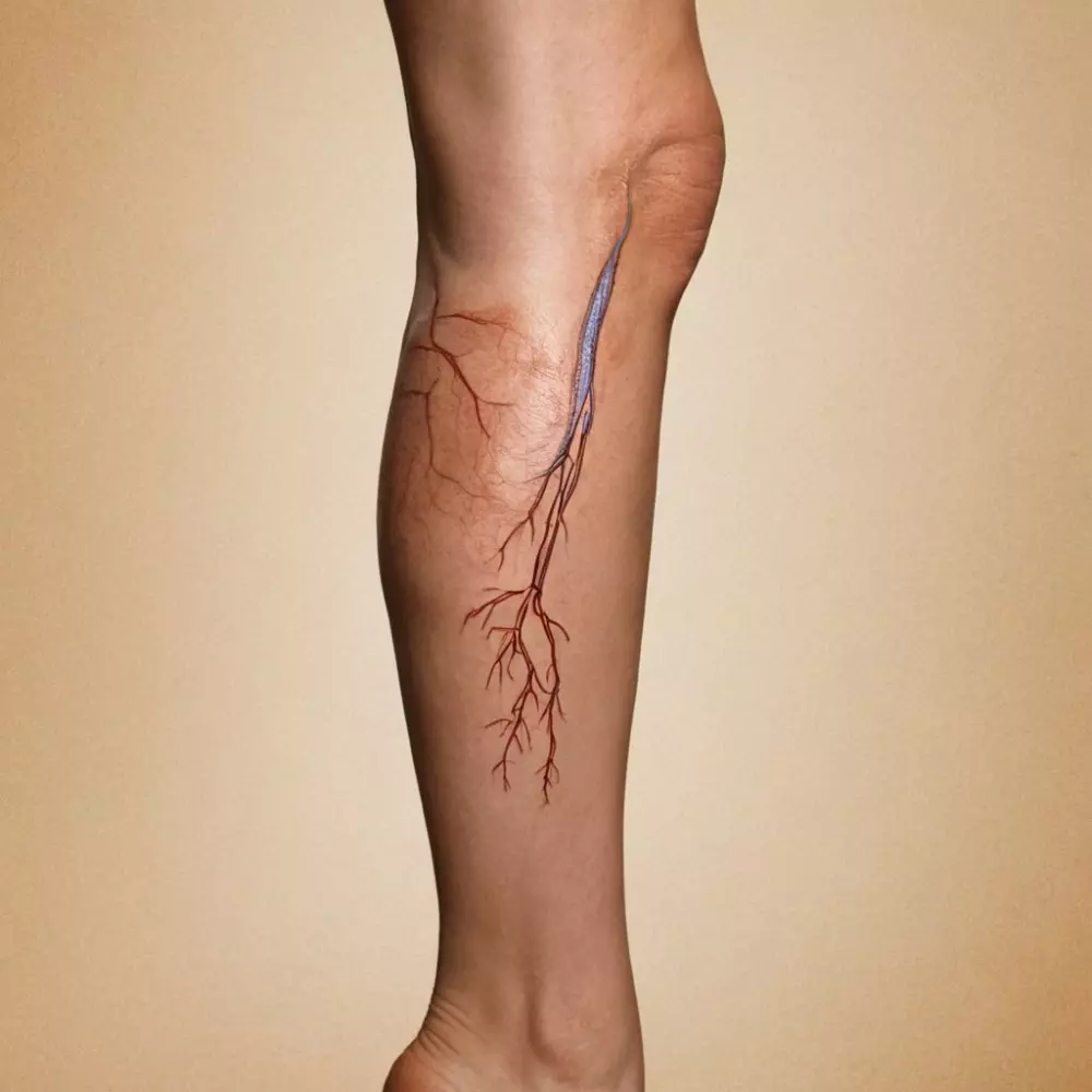 Ein Bein mit sichtbaren Krampfadern, hervorgehoben mit medizinischen Skizzen, um Behandlungsbereiche anzugeben, in einer klinischen Umgebung, fotografisch festgehalten mit einer DSLR-Kamera und natürlichem Licht.