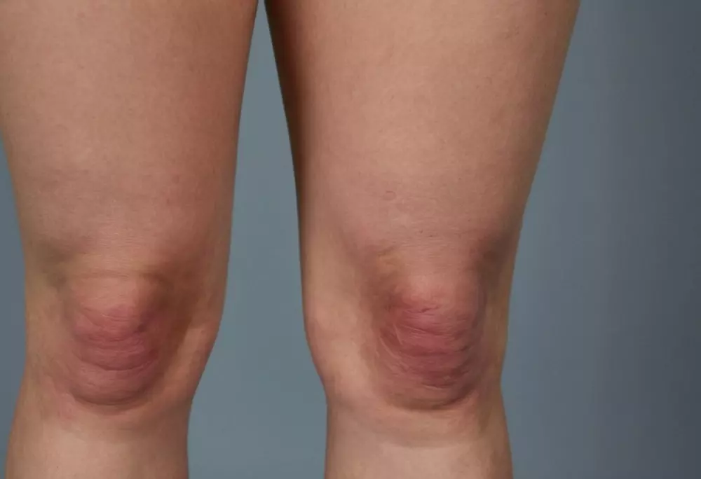 Nahaufnahme eines Beins, das spezifische Symptome einer oberflächlichen Venenthrombose zeigt, wie Rötung der Haut und Schwellung der Venen. Fotografie, hochauflösend mit detailliertem Fokus auf den Symptomen.