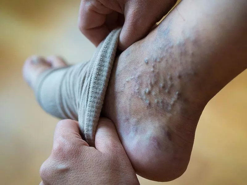 Eine Person legt einem anderen eine Bandage um den Fuß.