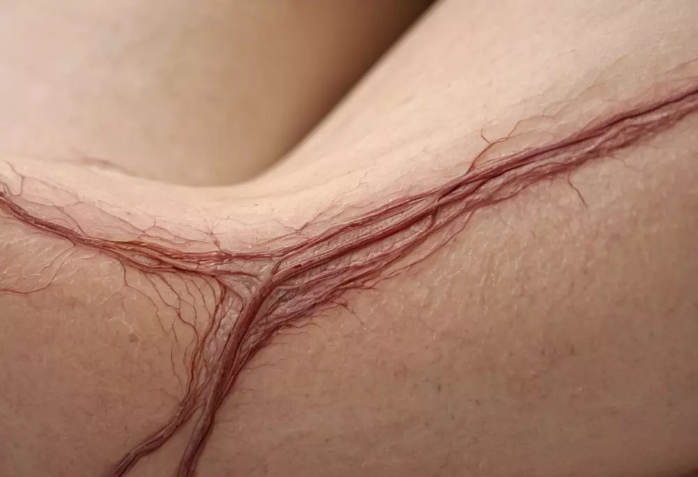 Detailaufnahme von Krampfadern an einem menschlichen Bein, die die verdrehten Gefäßstrukturen zeigen, in einer medizinischen Umgebung, Fotografie, die sich auf die Textur und Farbe der Venen mit hoher Auflösung und Klarheit konzentriert.