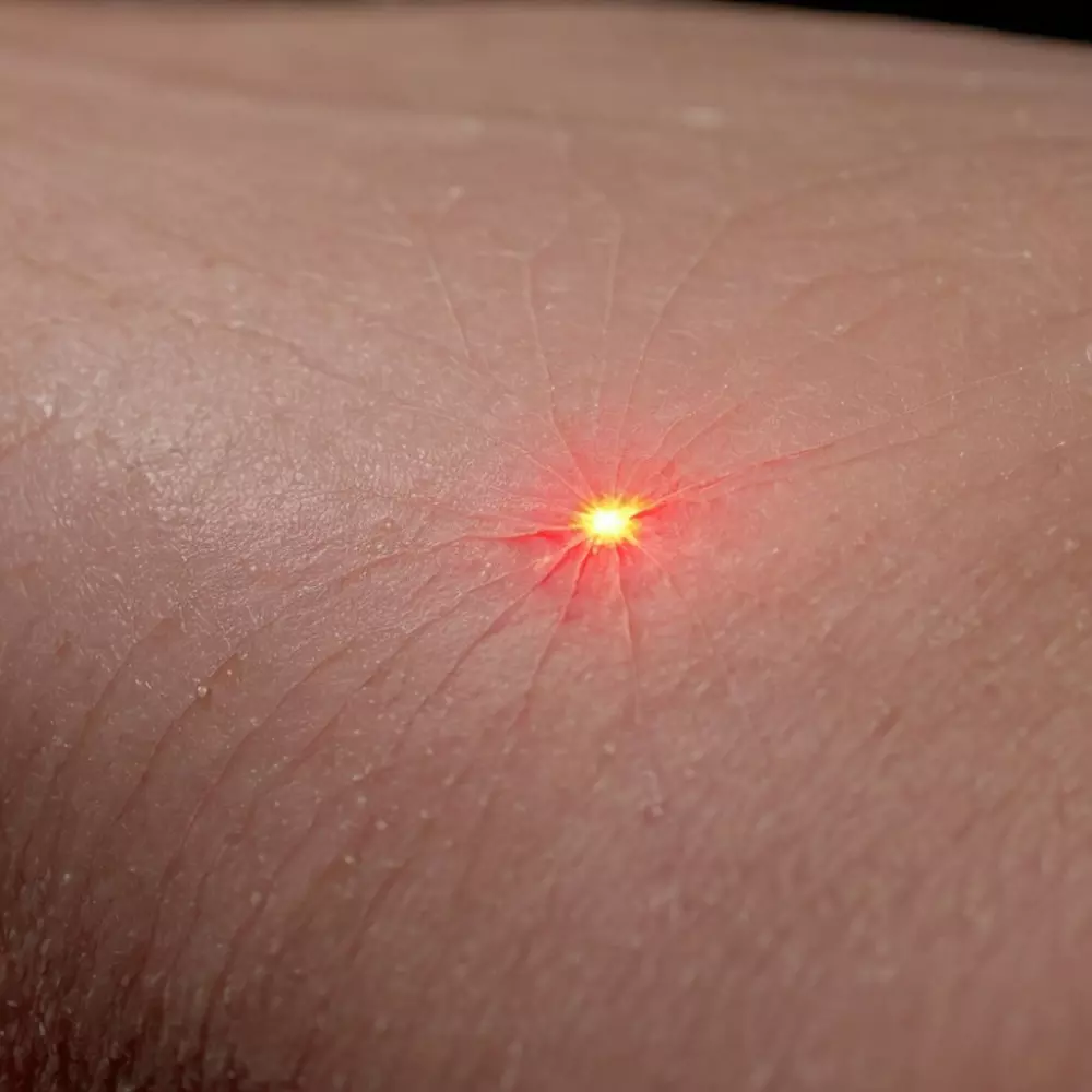 Nahaufnahme eines medizinischen Lasergeräts zur Behandlung von Besenreisern, das das Gerät und die Wechselwirkung mit der Haut in einer klinischen Umgebung zeigt. Fotografie mit Makroobjektiv unter klinischer Beleuchtung.
