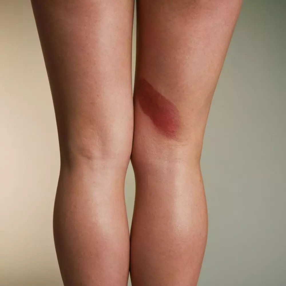 Nahaufnahme eines Beins, das Anzeichen einer Thrombose zeigt, wobei Rötung und Schwellung hervorgehoben werden, in einem einfachen klinischen Umfeld mit ernsthafter und informativer Atmosphäre. Fotografie, hochauflösend mit scharfem Fokus und weichem, natürlichem Licht.