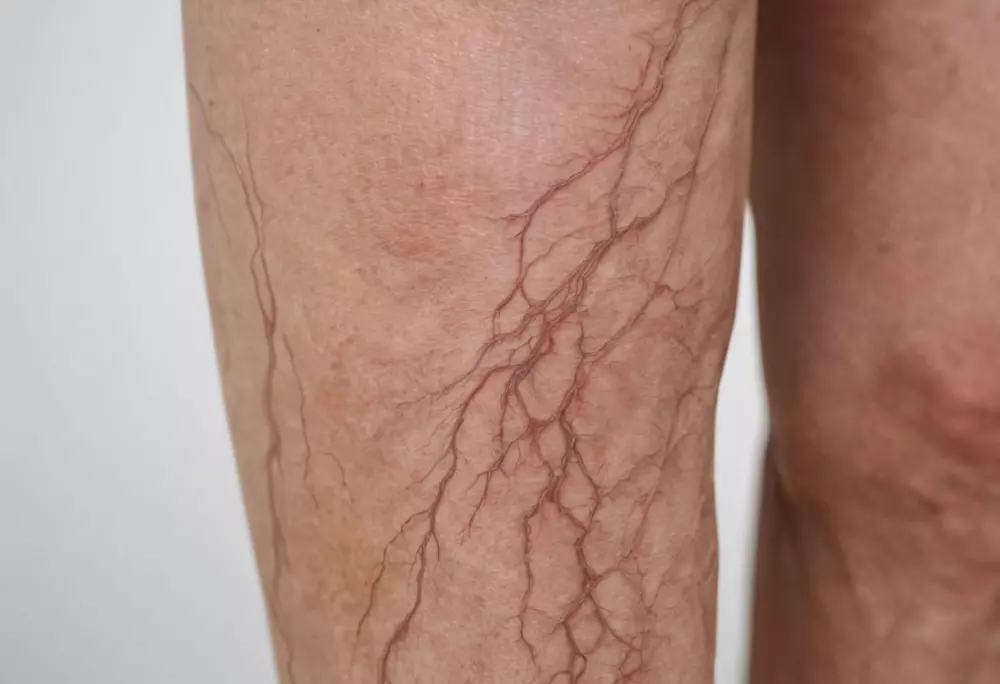 Menschliches Bein mit sichtbaren Krampfadern vor weißem Hintergrund, das den Zustand im Detail zeigt, fotografiert mit einem scharfen Fokusobjektiv.