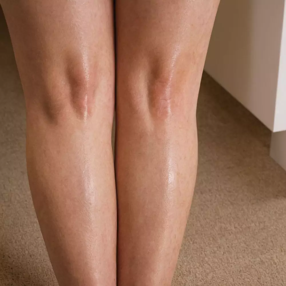 Nahaufnahme von Beinen, die vor und nach der Behandlung von Besenreisern zeigen, ein Bein mit sichtbaren Adern und eines behandelt und klar, in klinischer Umgebung, fotografisch festgehalten, mit Schwerpunkt auf Kontrast und Detail mithilfe eines Makroobjektivs.