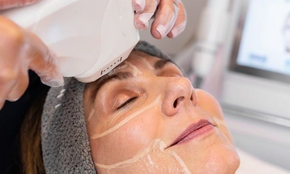 Hypho Face Lift: Your Guide to Ultrasound Facelifts | Dr. Linde blog