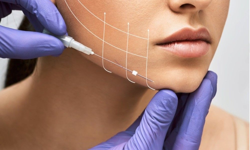 Understanding Collagen Threads Cost and Thread Lift Pricing | Dr. Linde ...