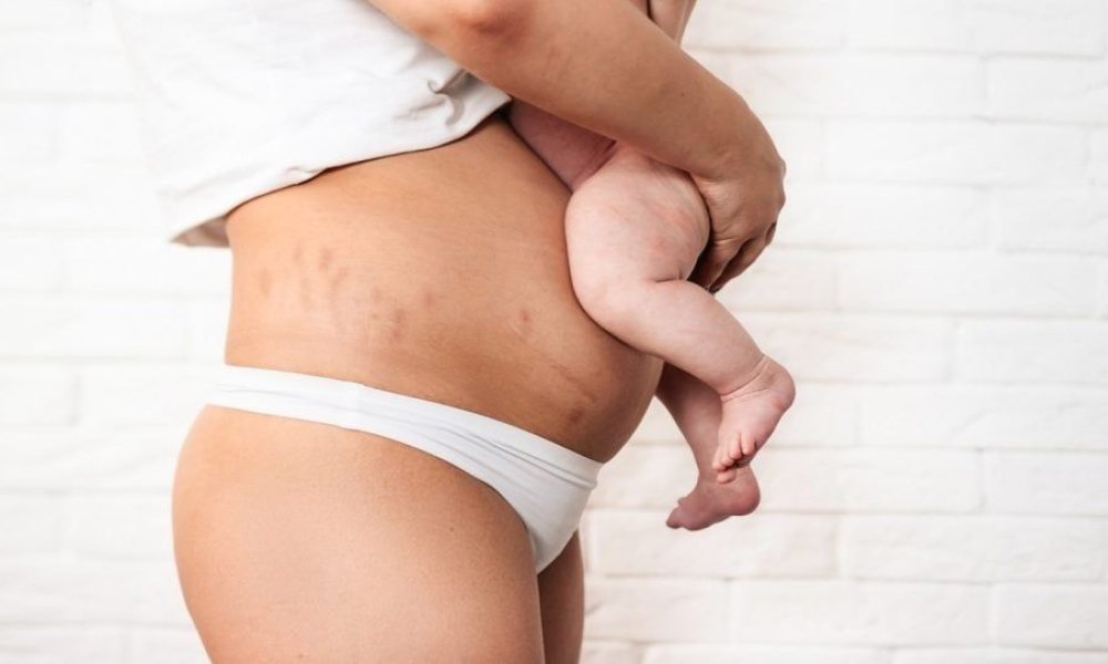 lipo for c section pouch Lipo After C Section: A Comprehensive Guide for New Moms