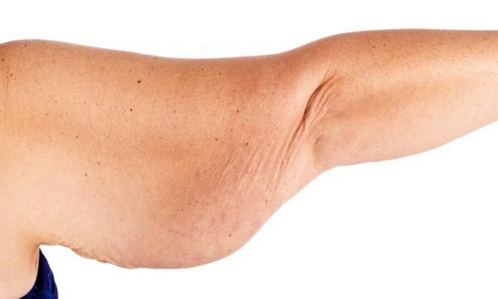 Comprehensive Guide to Bat Wing Arm Removal | Dr. Linde blog