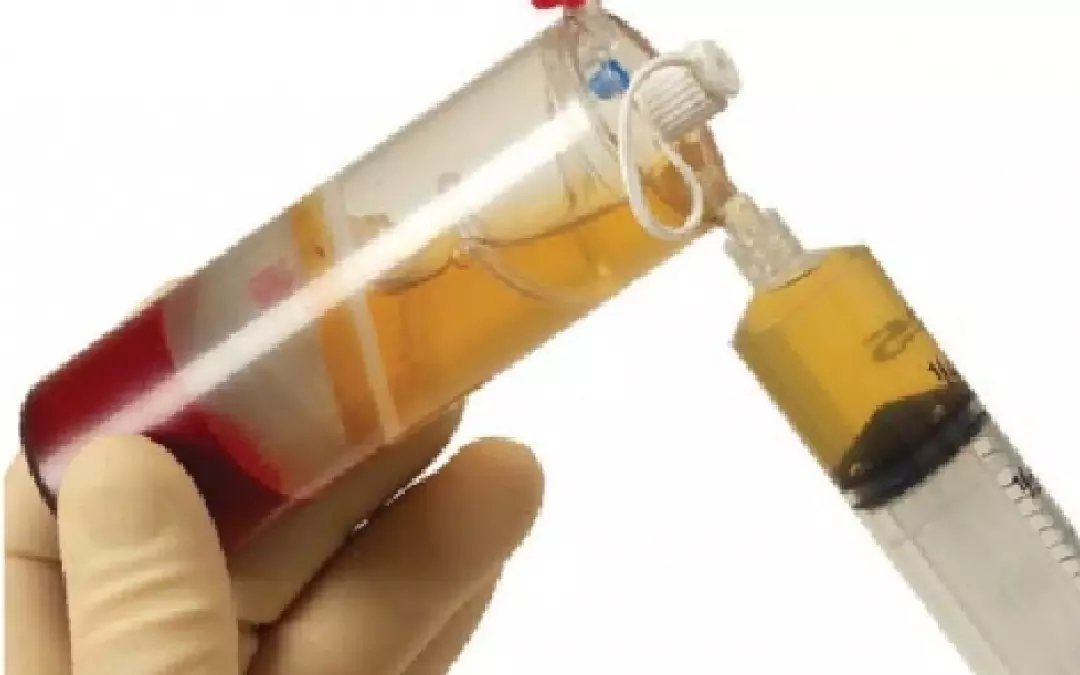 PRP (Platelet-Rich Plasma): Biostimulation mit Eigenblut und k&ouml;rpereigenem Plasma