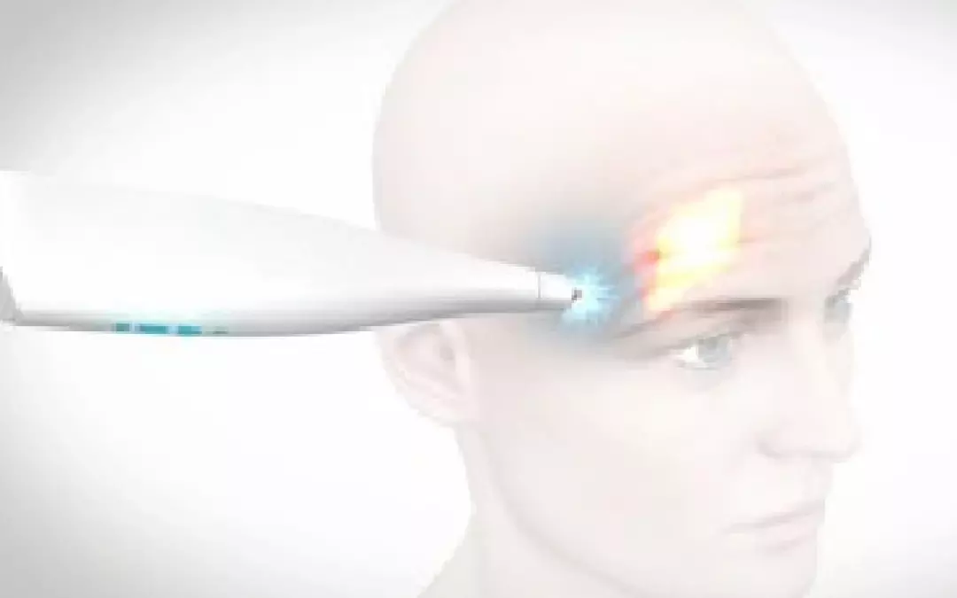IOVERA&reg; &ndash; Die Faltenrevolution ohne Botox
