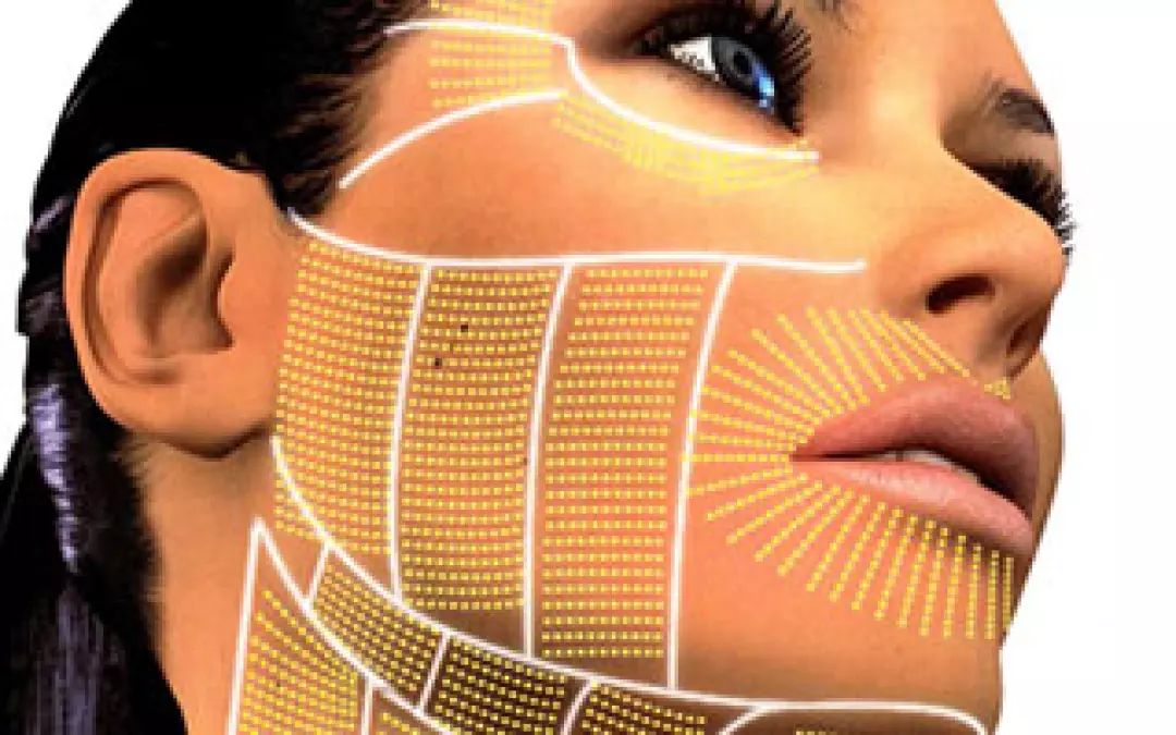 Silhouette Lift, die modernste Methode zur Straffung des Gesichtes innerhalb weniger Minuten