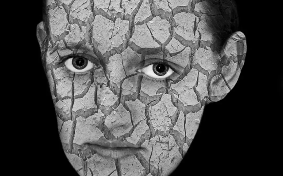 8 Tipps gegen Akne-Narben