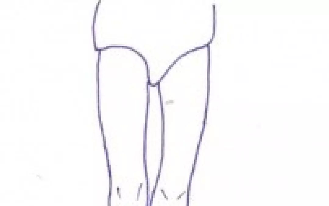 Der &ldquo;THIGH GAP&ldquo; &minus; ein neues Sch&ouml;nheitsideal