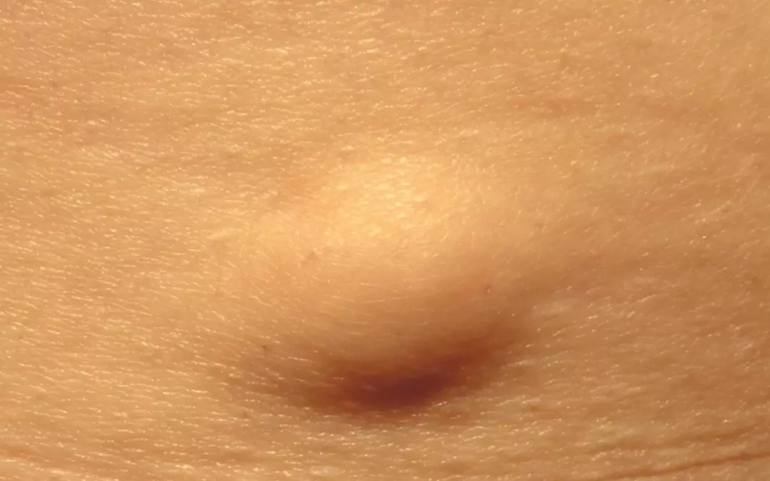Lipome &ndash; eine gutartige Fettgeschwulst
