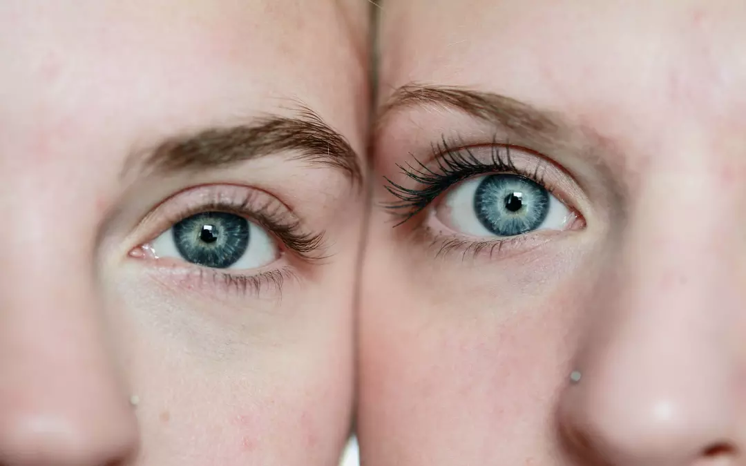 Augenringe effizient unterspritzen und entfernen