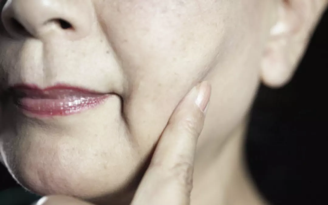 Dauerhafte oder l&auml;ngerfristige Behandlung der Oberlippenfalten