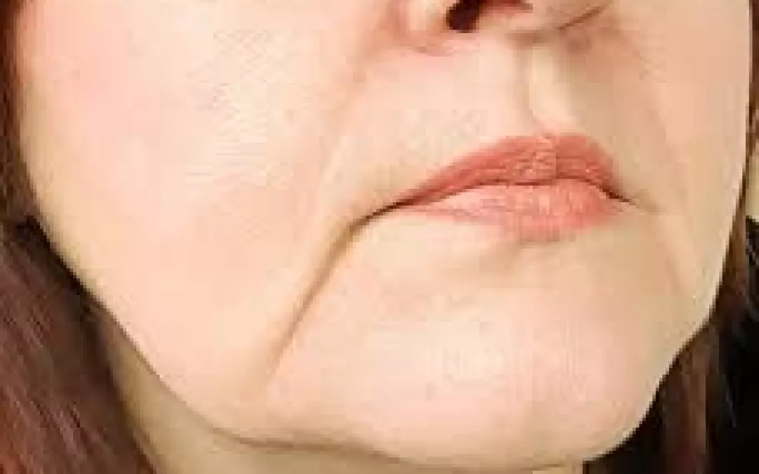 Understanding Marionette Lines: Causes and Treatments