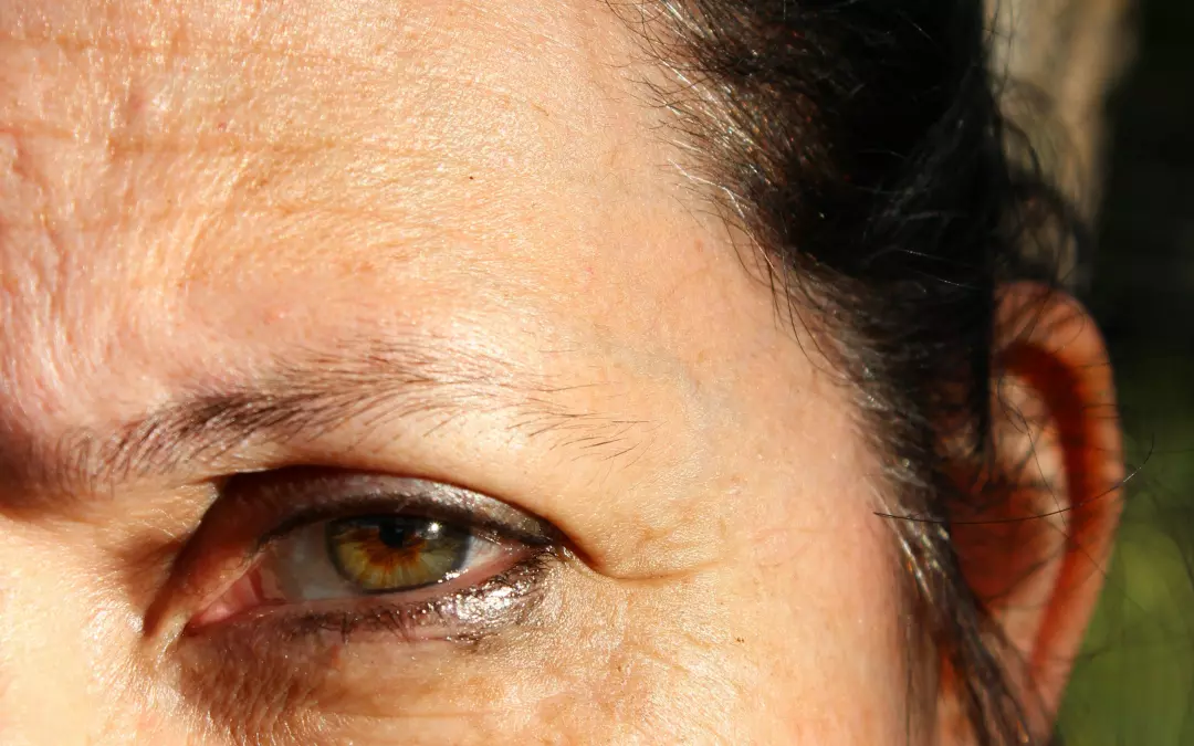Microneedling Kr&auml;henf&uuml;sse: Effektive Behandlung und Tipps