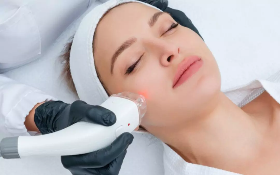 Q Switch Laser for Facial Hair: Comprehensive Guide