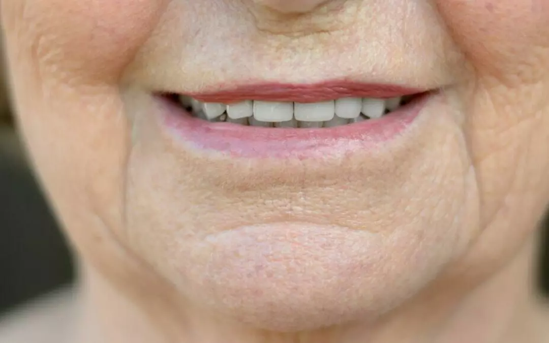 Understanding Filler in Mouth Lines: Causes and Treatments