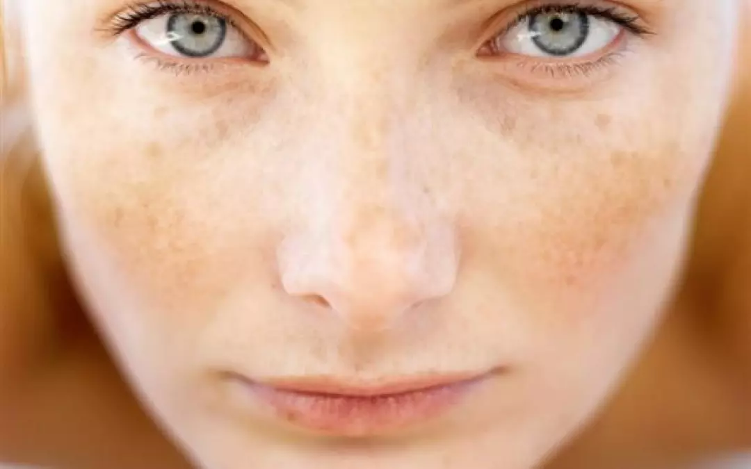 Sun Spot Removal Freezing: An Effective Solution