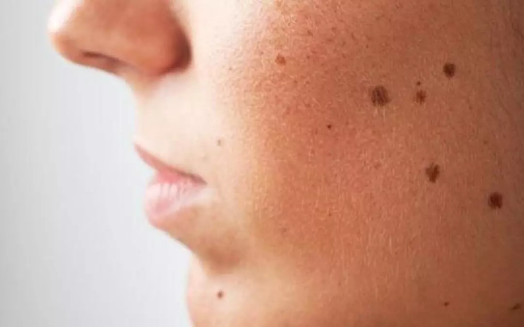 Lasering Moles Off Face: Comprehensive Guide and Insights